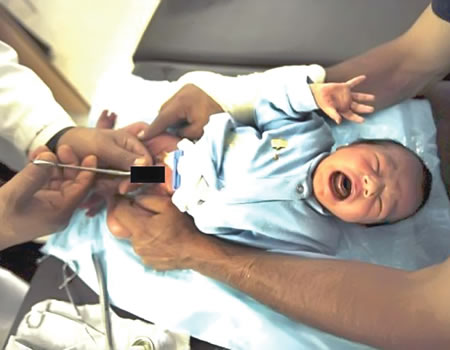 circumcision in children